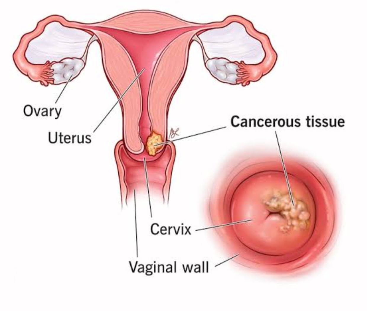 Cervical Cancer Kya Hota Hai