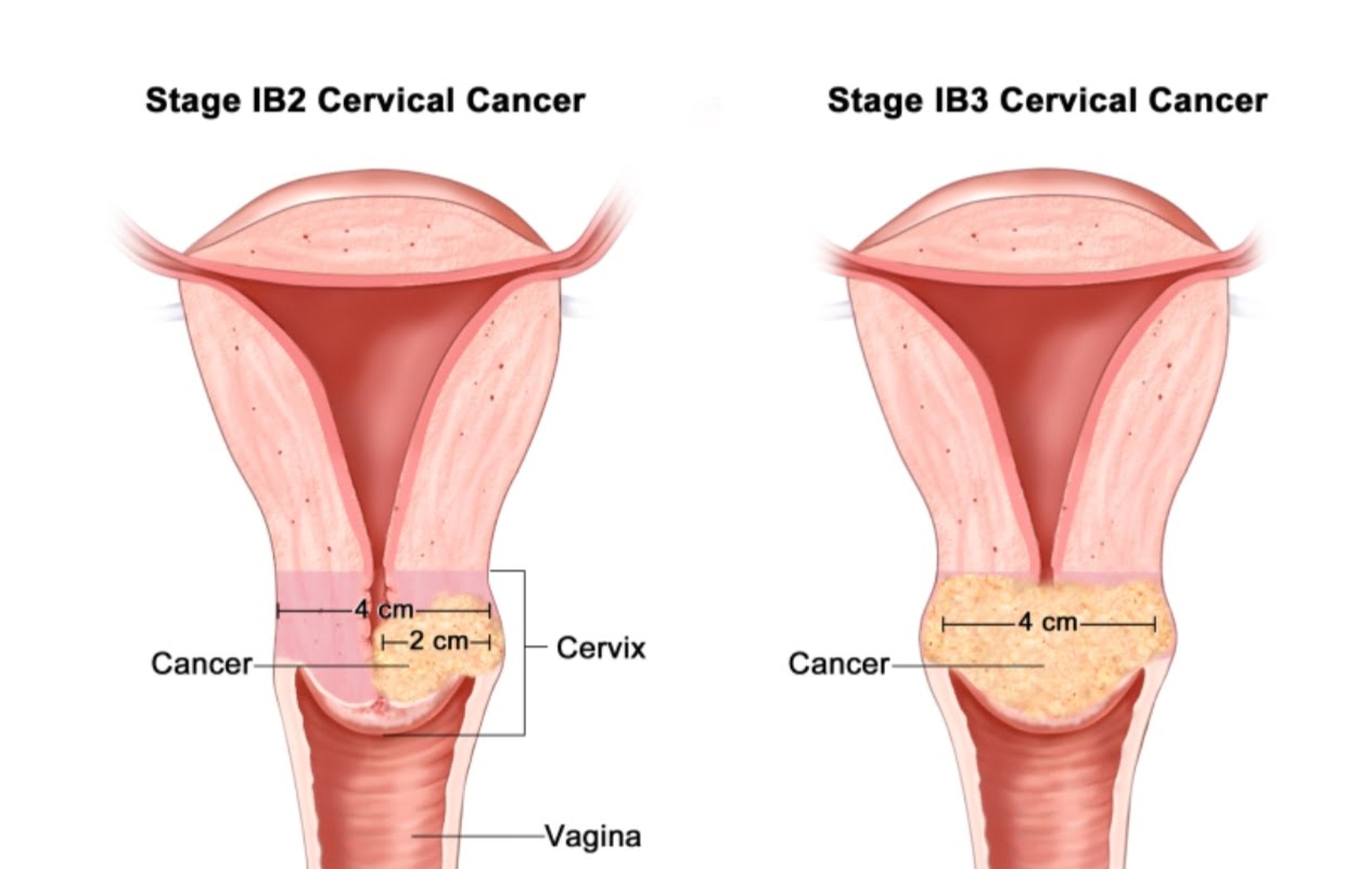  Cervical Cancer Ke Upchar